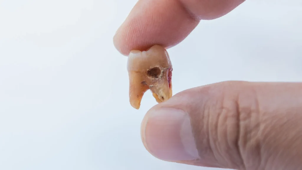Cavities in the teeth